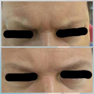botolife-antes-depois (1)