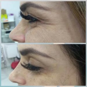 botolife-antes-depois (2)