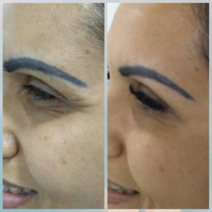 botolife-antes-depois (3)