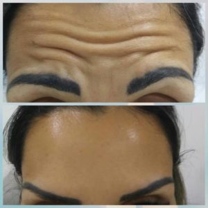 botolife-antes-depois (4)