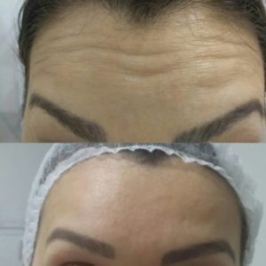 botolife-antes-depois (5)