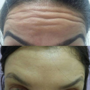 botolife-antes-depois (6a)