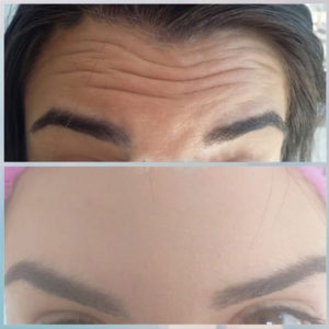 botolife-antes-depois (7)